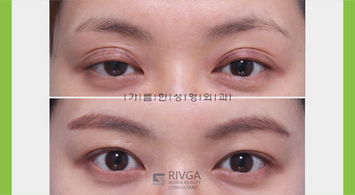 Korea Beauty Consultant Rivga 初対面では まず初めに相手を見る場所が目です 目が綺麗と相手の印象も良く感じられます 二重整形 目の再手術 目頭切開 目つき矯正 ぱっちり 大きい目