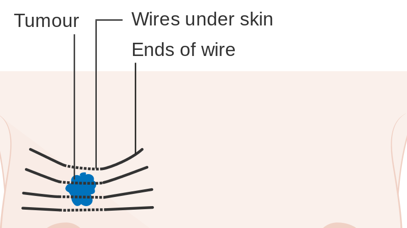 Brachytherapy or #internal beam #radiation is found to be an effective #treatment for #breastcancer .
Log on for unique researches of breast cancer  - goo.gl/mk3ktX
#Cancer #oncology #PMQs #MAMARedcarpet