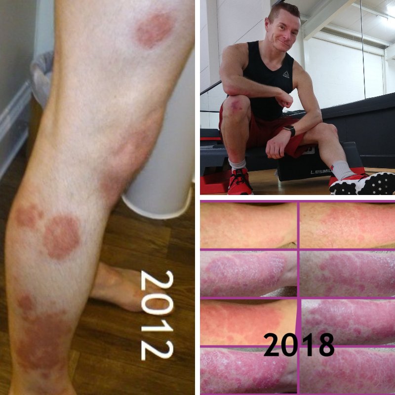 PsoriasisUK's tweet photo. 'What works for some, doesn’t for others but not getting too worried about what others think, and knowing that there WILL be days that it’s not as bad/noticeable is what helps me cope.' Read Robb's full '50 for 50' #psoriasis story here: https://t.co/5nGjW9Jqhk https://t.co/3g9eOfey4i