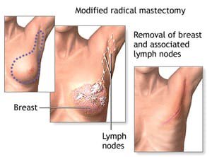 #Modified #radical mastectomy is done when Early #stage #breastcancer is detected. The #pros and #cons are identified and explained by #experts .
Log on to know more about #mastectomy and variants.
Log onto - goo.gl/Q3gaJs
#oncology #cancerresearch #MAMARedcarpet
