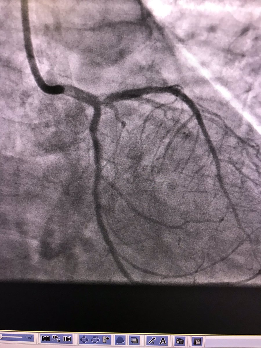 istentem's tweet image. #radialfirst,#protectedpci .though femoral and no impella, I thought it was worth posting.