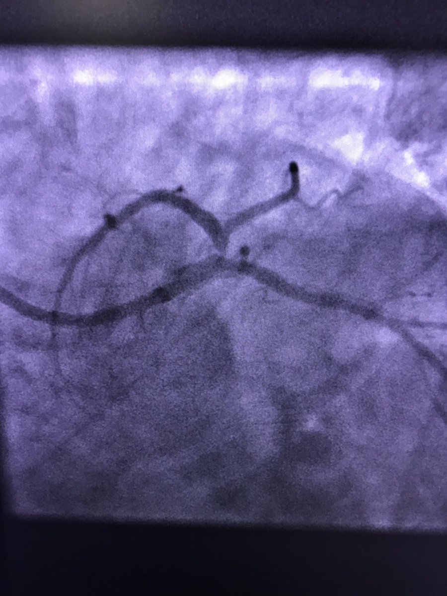 istentem's tweet image. #radialfirst,#protectedpci .though femoral and no impella, I thought it was worth posting.