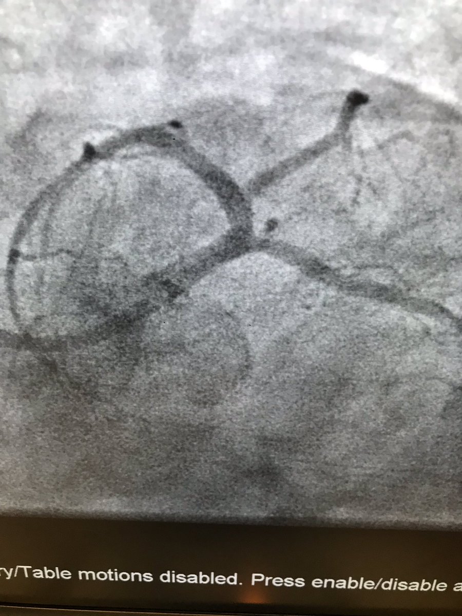 istentem's tweet image. #radialfirst,#protectedpci .though femoral and no impella, I thought it was worth posting.