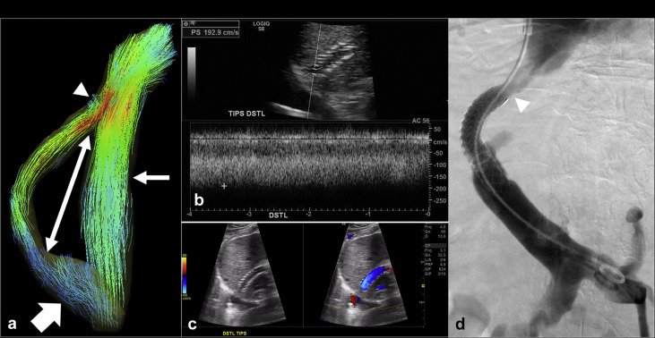 JVIRmedia's tweet photo. The Feasibility of Using Volumetric Phase-Contrast MR Imaging (4D Flow) to Assess for Transjugular Intrahepatic Portosystemic Shunt Dysfunction | https://t.co/Cv1VKqebhL #irad @RadProfJO https://t.co/COVRb1wva8