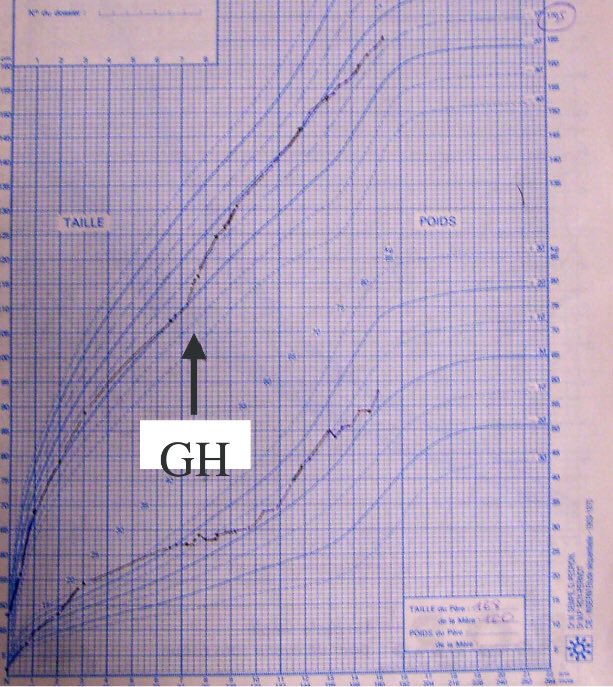 PraderWilli2's tweet photo. Voilà l’évolution de la croissance d’un enfant qui est sous hormones de croissances (GH) . #BelkhodjaGhalia https://t.co/KjsvzaC5IT