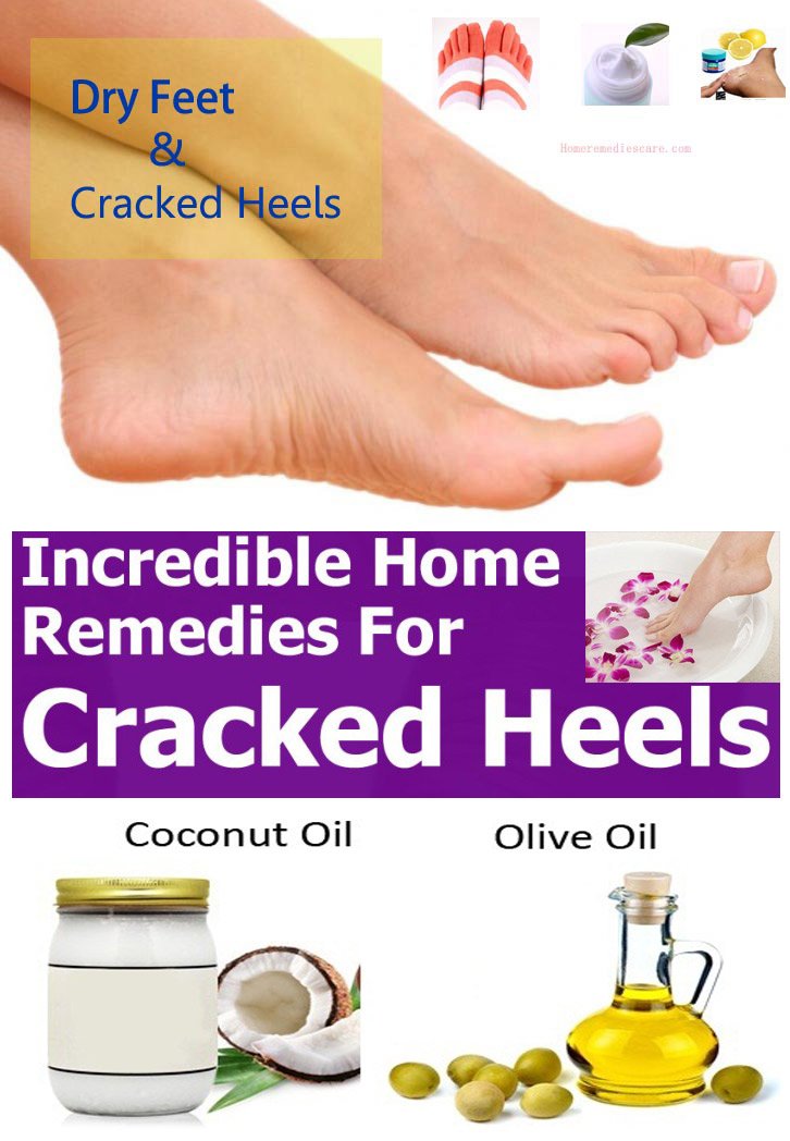 Cracked Heels: At Home Remedies and Prevention - Natural Skin Revival