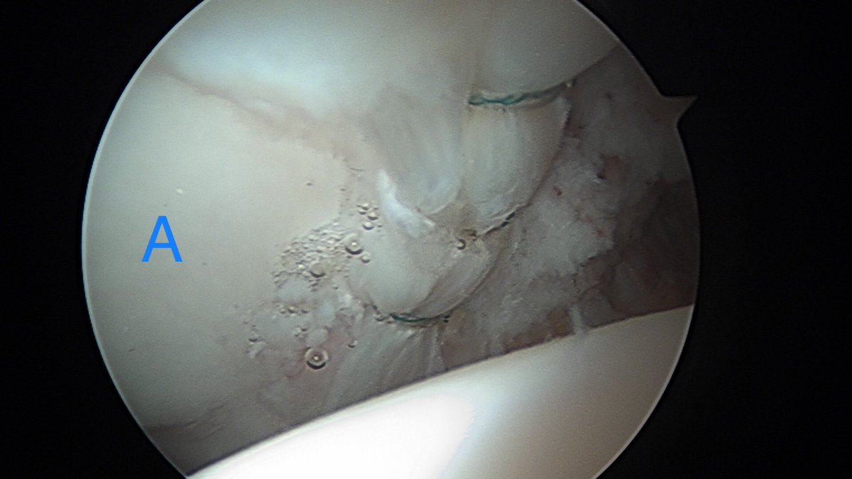 DrDerekOchiai's tweet photo. Form follows function. In #HipArthroscopy, if the surgical result mimics what a normal hip would look like, the outcomes are better. Pics: one hip had a labral repair, the other had a labral reconstruction with a graft. Can you tell which is which? #SportsMedicine https://t.co/cpxZESsIxU