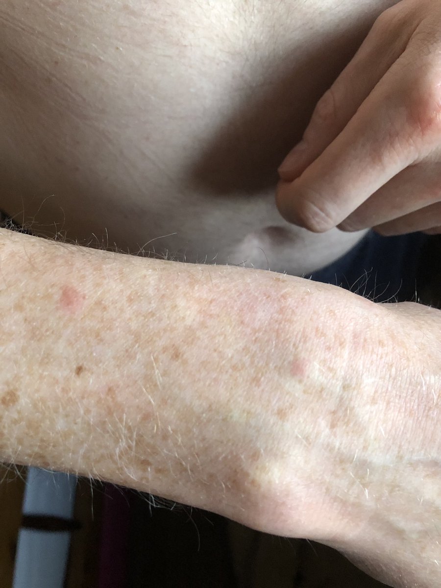lottiedesigns's tweet photo. @NextHelp I’ve emailed you two days ago about these bites by boyfriend got after wearing a brand new shirt from you. Yet no reply!?!? https://t.co/KjVzcr7i3w