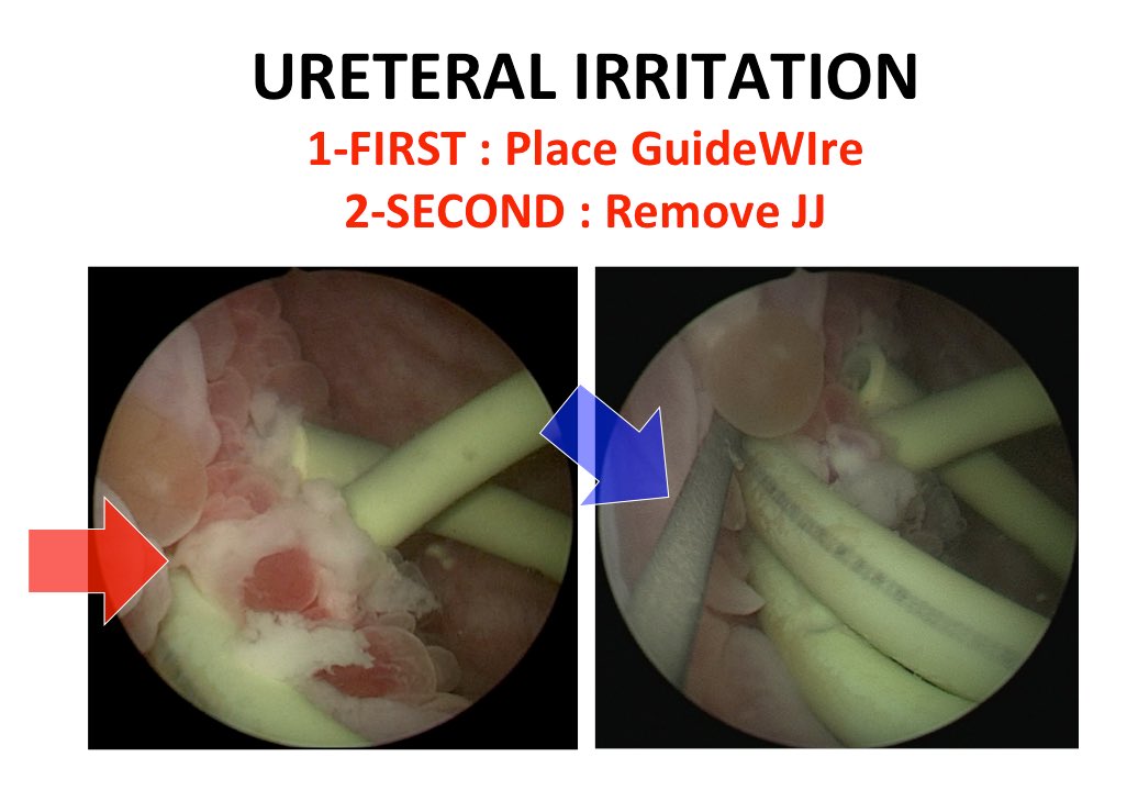 T&amp;T98: In case of ureteral irritation (oedema+++ at ureteral orifice UO).If JJ is in place,don’t remove it. You may have difficulties to see again UO. Place FIRST a GuideWire alongside the JJ &amp;then remove JJ. Much Easier &amp;Safer. Hydrophilic wire are great in this situation