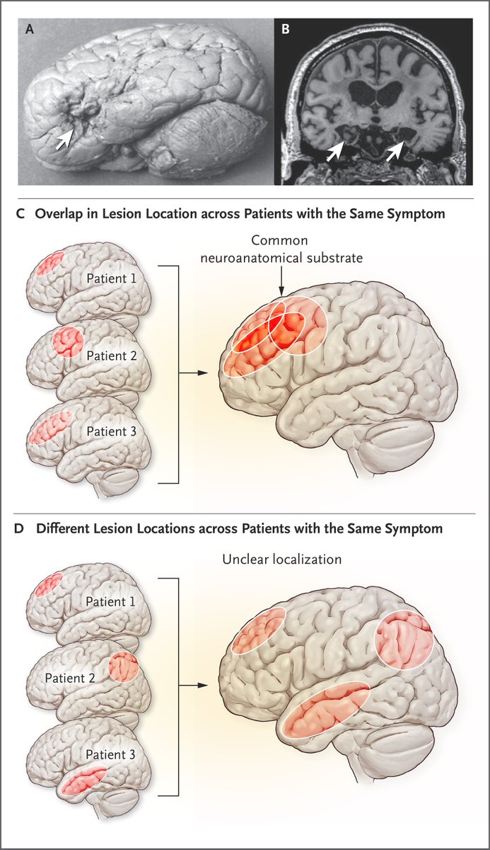 groei Behoort AIDS NEJM on Twitter: "Symptom Localization from Focal Brain Lesions: Overlap in lesion location across patients with the same symptom can identify a common neuroanatomical substrate. Learn more: https://t.co/uEicRbBxmh https://t.co/nTnRvf4IFm" / Twitter groei Behoort AIDS NEJM on Twitter: "Symptom Localization from Focal Brain Lesions: Overlap in lesion location across patients with the same symptom can identify a common neuroanatomical substrate. Learn more: https://t.co/uEicRbBxmh https://t.co/nTnRvf4IFm" / Twitter
