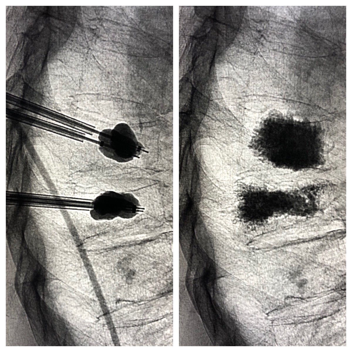 MTV_IR's tweet photo. 77 year old man with s/p fracture of T8 and T9 w/persistent back pain after failing conservative therapy. T8 and T9 kyphoplasty w/relief of pain.
#MTVIR #ExpertInterventionalRadiologist #BackPain #Pain #CompressionFractures #VCFs #BalloonKyphoplasty #irad #miips @drprestongs https://t.co/vs0L7cM8zo