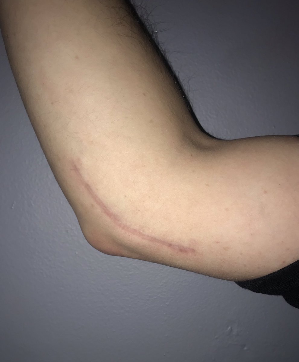 RyanMoravek's tweet photo. It’s been 6 months and 11 days since I had Tommy John surgery and over 7 months since I last threw a baseball. Today I got the best early Christmas present ever...clearance to start throwing once again. I still have a long haul but I’m not giving up. https://t.co/yIKxl8ZlaW