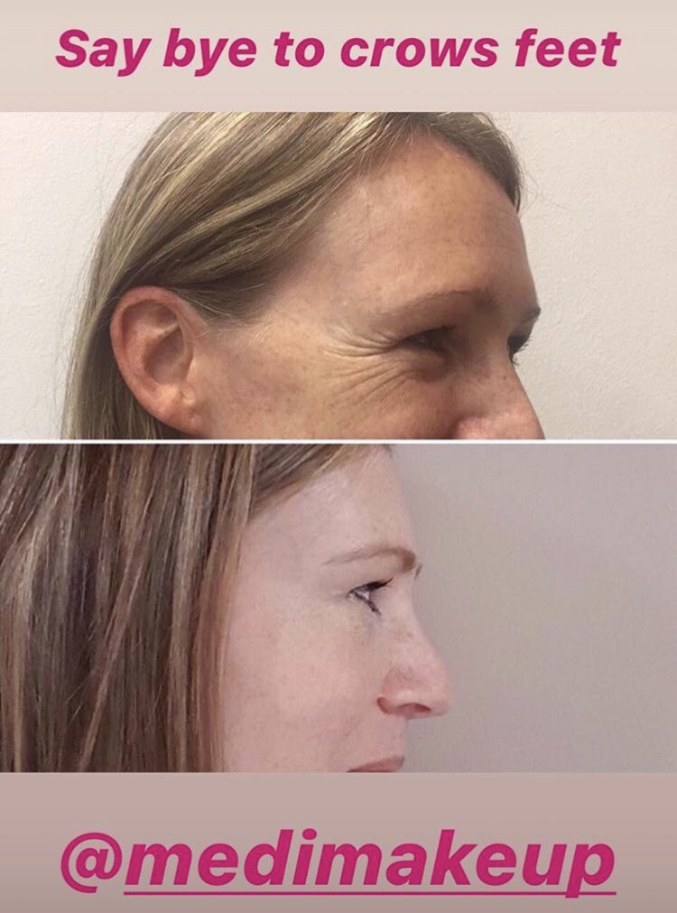 Medi_makeup's tweet photo. Insane! 😍 #AntiWrinkle Injections #CrowsFeet #Eyes #Beauty #MediMakeup https://t.co/2wfPltelIl