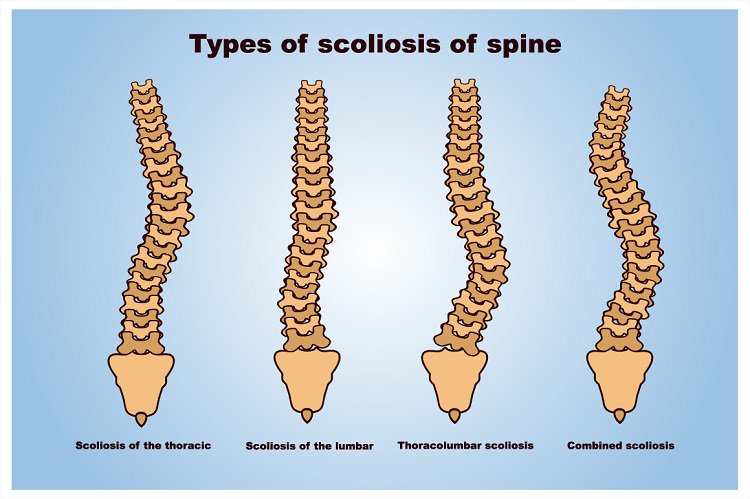 #healthy #Bones  are a factor in a #women 's life. #Osteoporosis and #scoliosis are the condition which affects women of different stages.Know more about scoliosis and #spine defects 
Log onto goo.gl/v2jQmk  
#spine #BoneSpurs #orthodontics #ItsTheLoveShot #FelizJueves