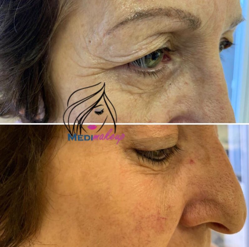 Medi_makeup's tweet photo. Look at the before and after 👀 Incredible results with Anti-Wrinkle injection @Medi_makeup ✨ https://t.co/j6wDpAs8Xm