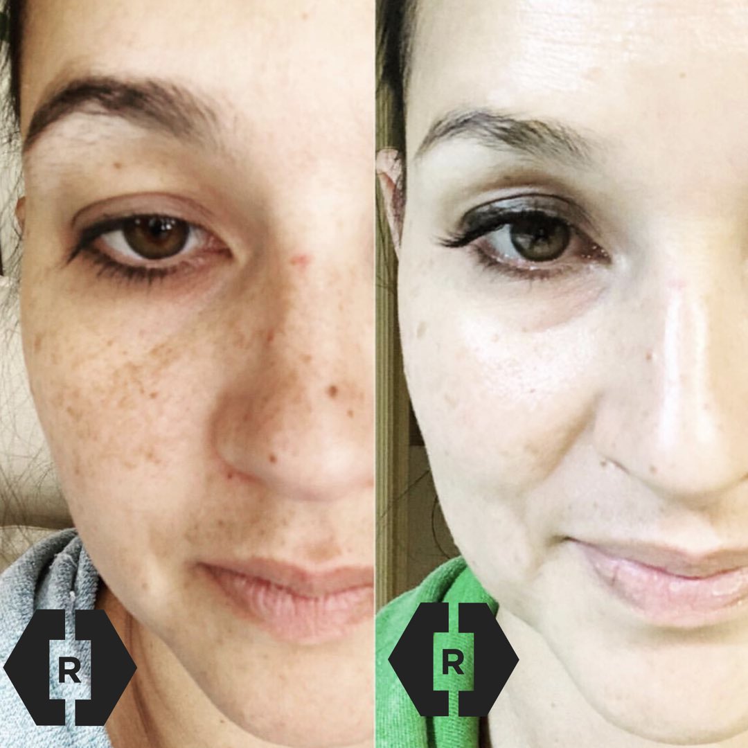 ReviveMobile's tweet image. This before and after if after ONE TREATMENT of microneedling for her hyperpigmentation.  ONE TREATMENT!!  Book yours today at revivemobile.com