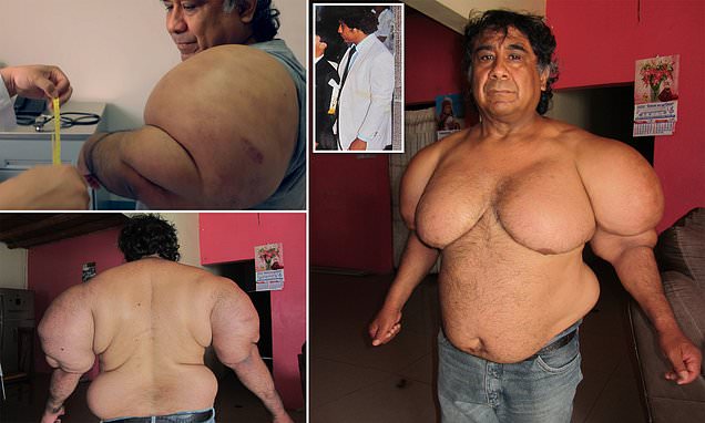 mnaEN's tweet photo. Dad whose body #ballooned like Popeye after accident finally finds out why
#AlejandroRamos air hose was cut as he was diving deep underwater #four #years ago.

#MNA_English        #MNA
#Anglophones https://t.co/SAsTJqHR2B