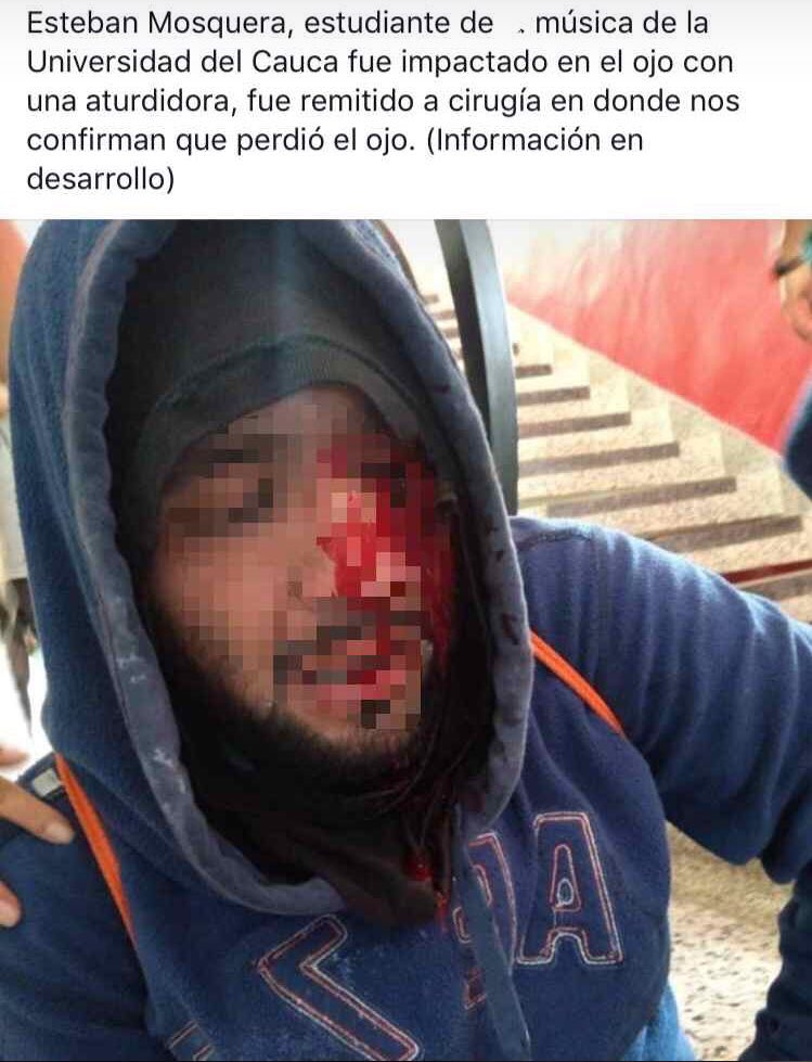 ¡Por favor difundir! Esto fue consecuencia de los ataques que recibimos los estudiantes de UniCauca por parte del ESMAD hoy en Popayán. #ConRepresiónNoHayNegociación #VivanLosEstudiantes #EstudiantesNoDelicuentes