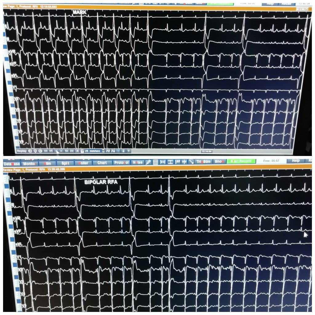 Bipolar RF:rvot  PVCs refractory for unipolar abln,Bi abln done using catheters at earliest site septal rvot nd Lcc,late at AMC nd GCV. its designed by us in no time during the case, before giving it up after uni abln at rvot nd lcc,with concept of Bipolar abln -#Navxian india👍