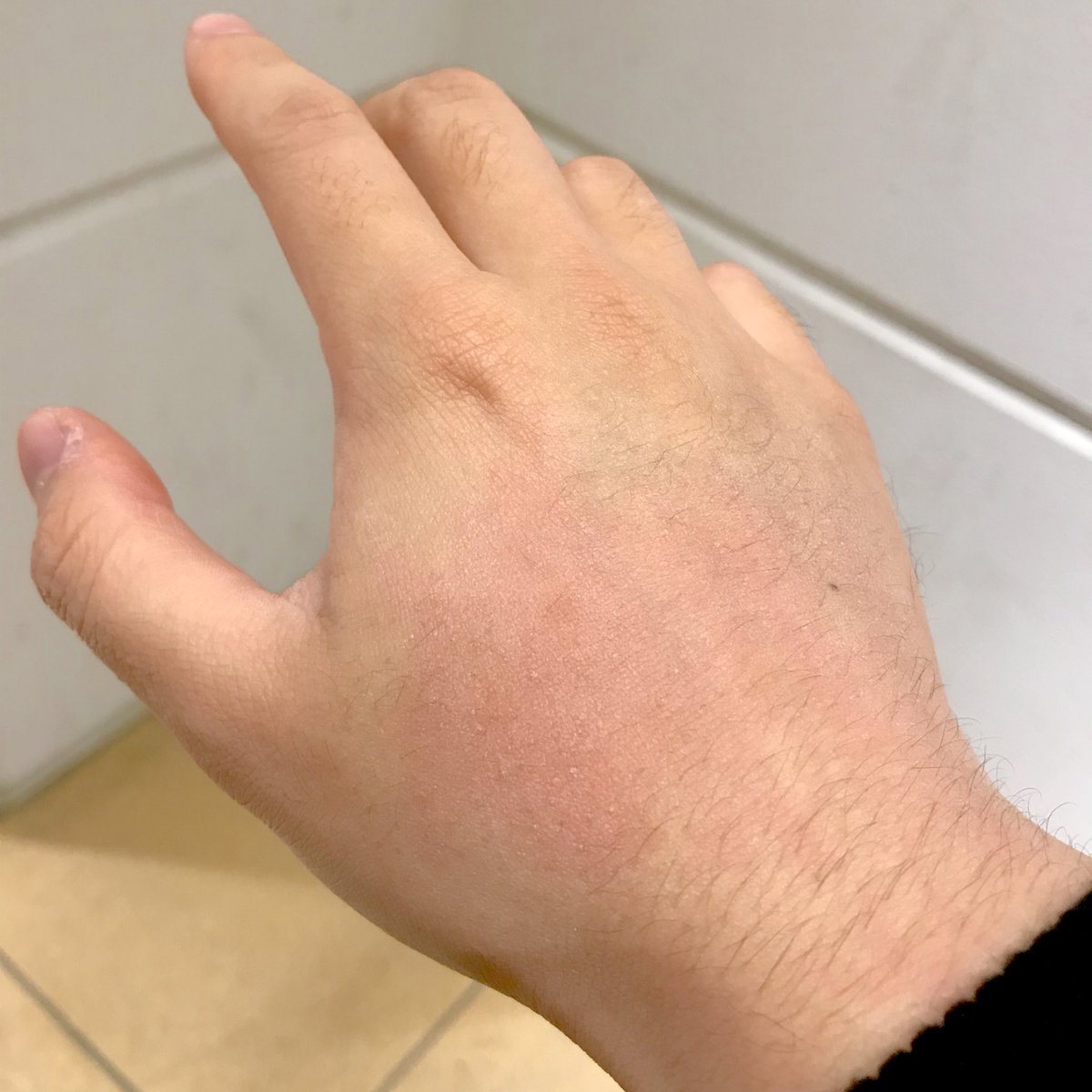 エビ アレルギー えっ 大人になってからでも有りうる エビアレルギーとは