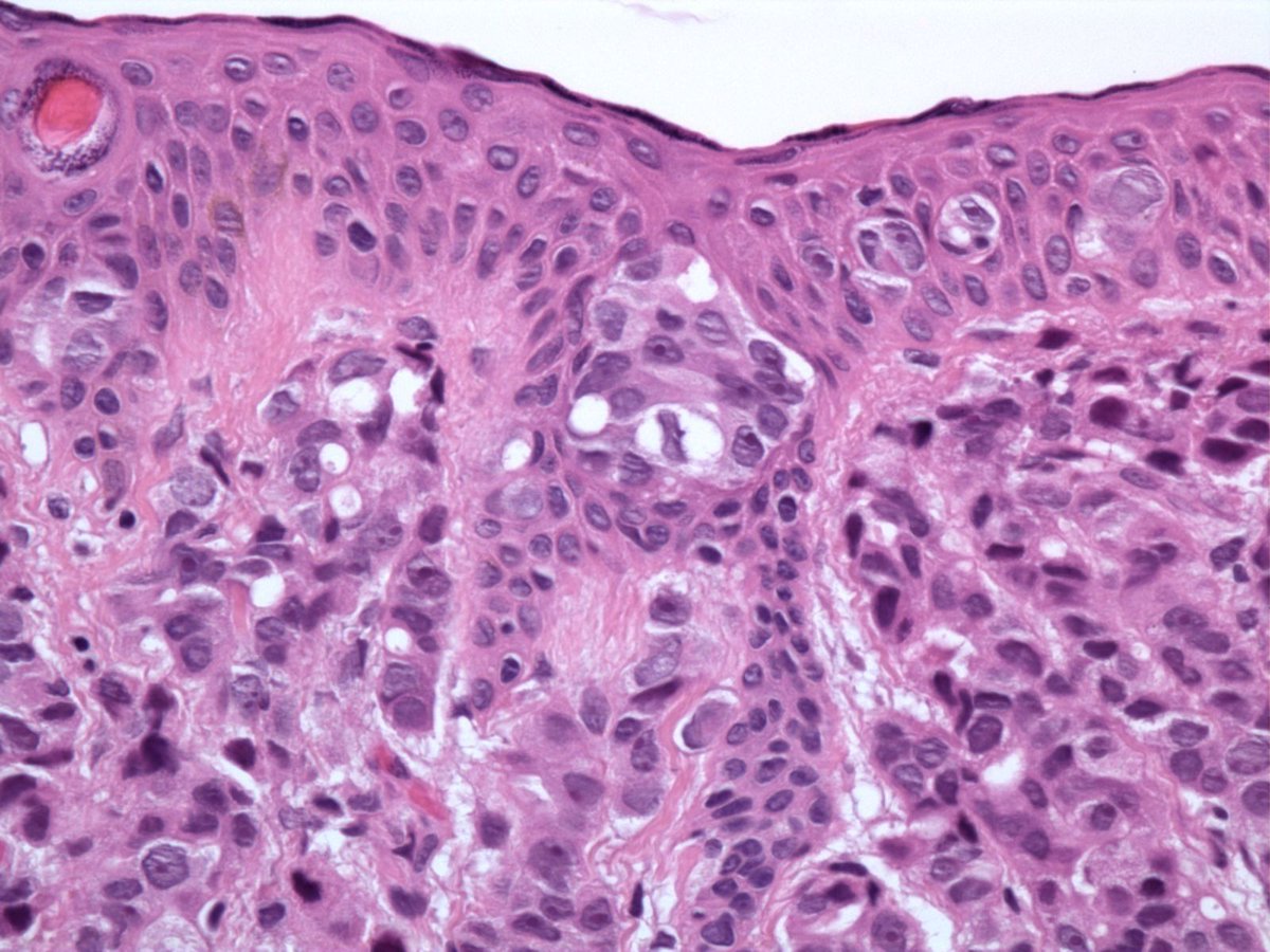 JMGardnerMD's tweet photo. Metastatic prostate cancer in skin (it's epidermotropic, meaning dermal metastasis infiltrates epidermis mimicking carcinoma in situ. can cause confusion with skin primary. can happen in melanoma too). Very rare. PSA+. Pics: @SteveBillingsMD #Pathology #dermpath #dermatology https://t.co/NmyJ3Uqkwg