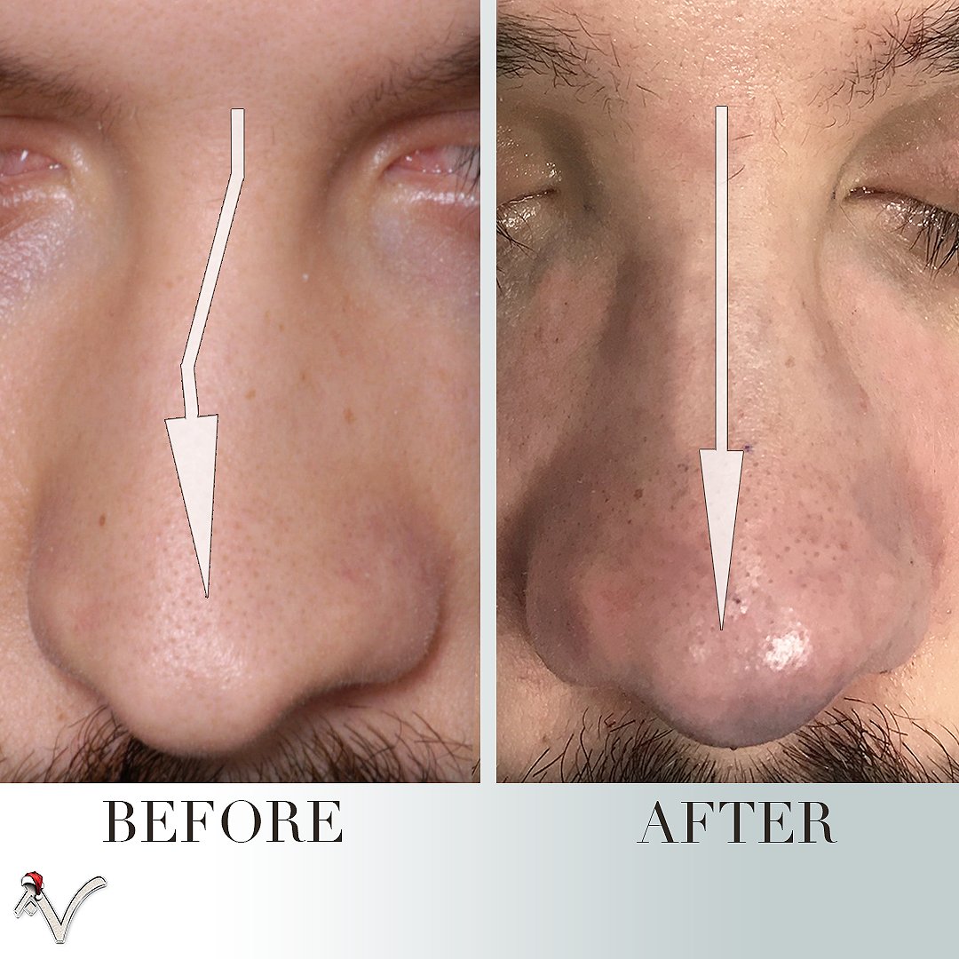 ArmenVartany's tweet photo. I was able to make this very crooked nose almost completely
straight. Correcting a crooked nose is one of the most difficult aspects of
rhinoplasty.
-
-
#CrookedNose #DeviatedNose #SeptalDeviation  #Rhinoplasty
#Septoplasty https://t.co/ViN3iLh2mR