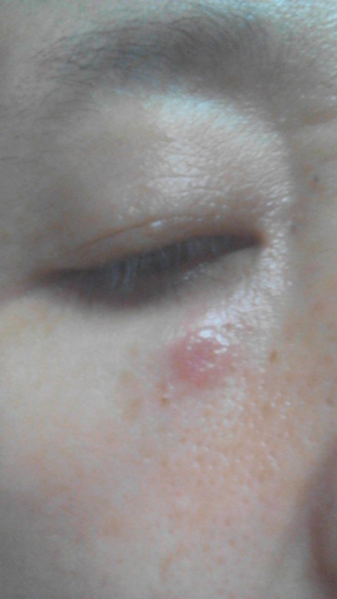 O Xrhsths Mmfuku Sto Twitter 右目の下に火傷のような水泡ができて潰れていた 昨夜はなかったはず 就寝中にやられたらしい 皮膚の薄い下瞼だし 跡残りそう