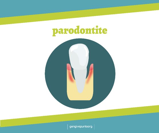 La #parodontite è una malattia infiammatoria che colpisce i tessuti attorno al dente come la gengiva, l’osso ed il legamento parodontale, causandone una perdita progressiva. Eppure pochissimi la conoscono! Scopri di più su gengive.org