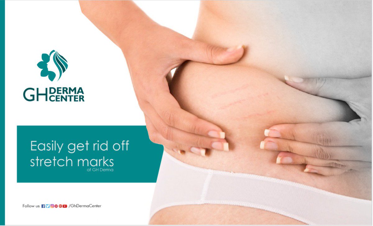 ghdermacenter's tweet photo. Improve on the appearance of your skin by removing #stretch_marks with the help of #fractional_laser_light. The stretch marks will permanently disappear, and you will be ready to bare the skin with confidence.
#GH_DERMA_CENTER #Dermatologist
#Gursharan_Hospital
9914697000 https://t.co/NsPmVO9H3K