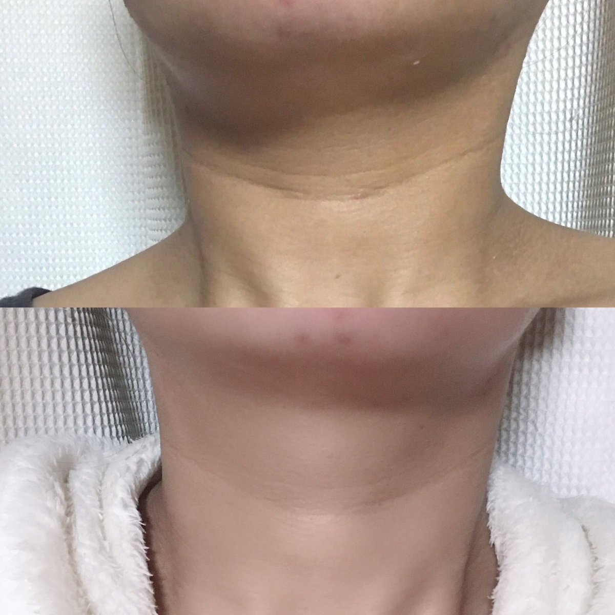 桜木梨花 フリーライター 実は11月から 欲しい所にだけ脂肪をつける ボーテロンドを実験したのですが約1ヶ月経ちまして 生まれつきの首の横皺がかなり薄くなりました 無加工です ダイエット商品等は沢山ある中 脂肪をつける という発想素晴らしい