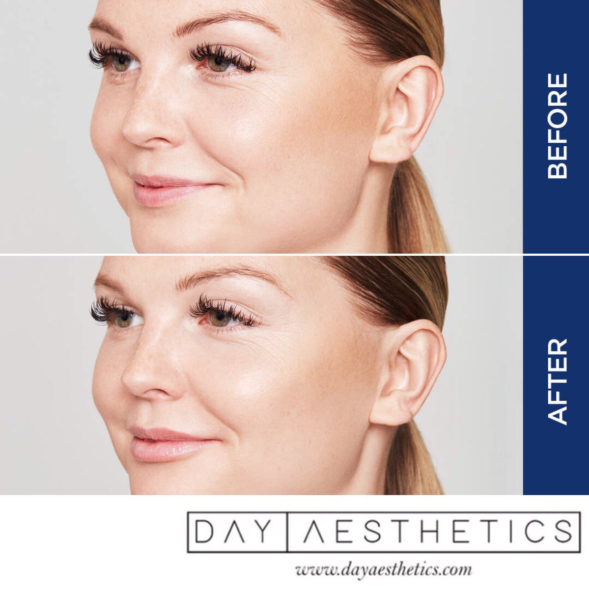 <a href="/day_aesthetics/">Day Aesthetics</a> Lichfield we use @Restylane Hyaluronic Acid Dermal Fillers for Lip Enhancements. To find out more... visit dayaesthetics.com #lipfillers #aesthetics #restylane