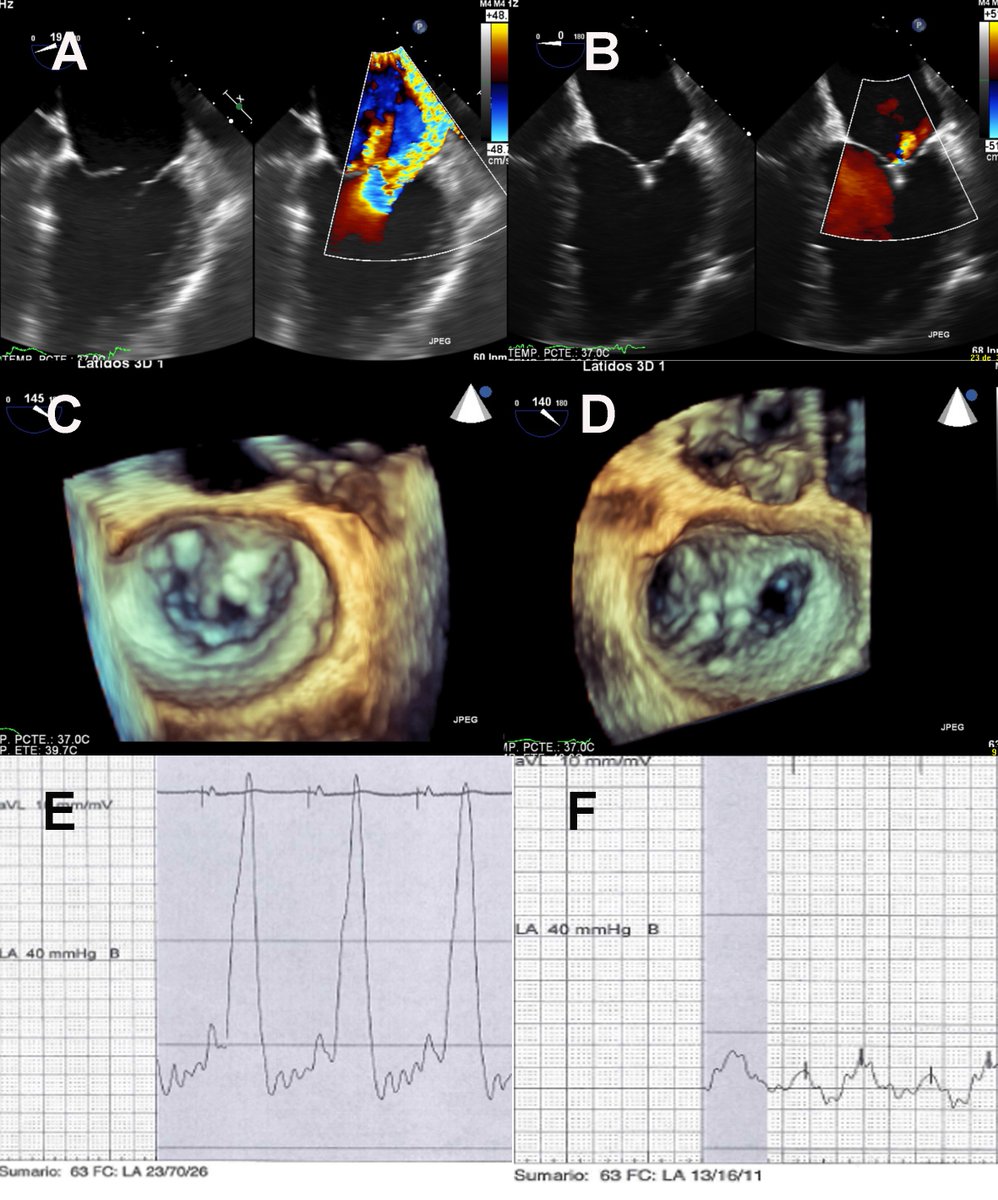 JHeartValveDis's tweet photo. #MitraClip Repair in #Cardiogenic Shock Due to Acute #Mitral #Regurgitation: From Near-Death to Walking https://t.co/RwsdjzHEvE https://t.co/FDl0BnjVdu