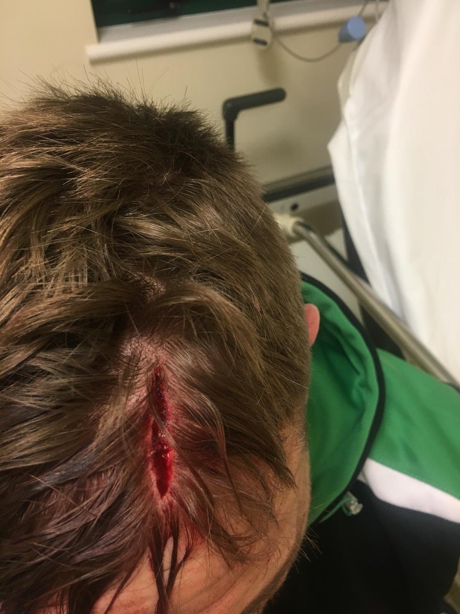 Cameron Pierce On Twitter Ouch Hope It S Just A Few Staples And No Brain Injury Concussion