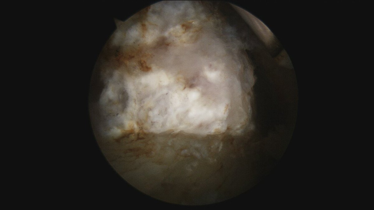 cirugiadecadera's tweet photo. AIIS Avulsion a common pediatric injury. Conservative still the standard but in some patients a well displaced spine may "heal" too distally causing in the upcoming years an extra-articular impingement called SUBSPINE SYNDROME. Endoscopic trimming of the deformity usually helps https://t.co/cxp2OCFoaP
