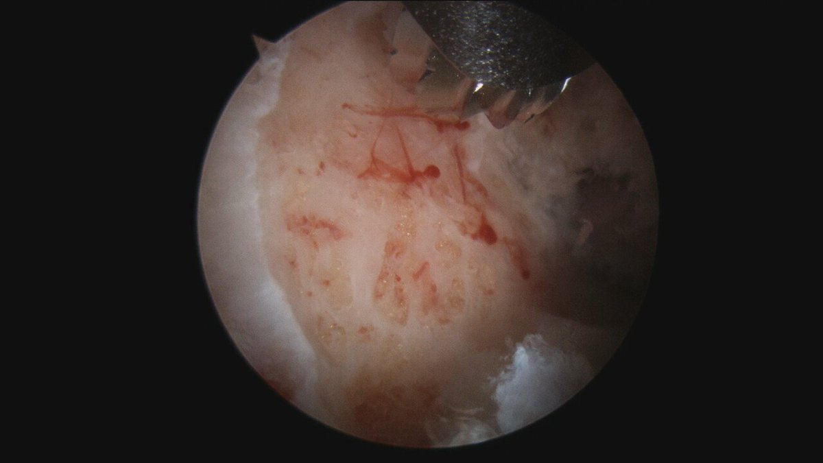 cirugiadecadera's tweet photo. AIIS Avulsion a common pediatric injury. Conservative still the standard but in some patients a well displaced spine may "heal" too distally causing in the upcoming years an extra-articular impingement called SUBSPINE SYNDROME. Endoscopic trimming of the deformity usually helps https://t.co/cxp2OCFoaP
