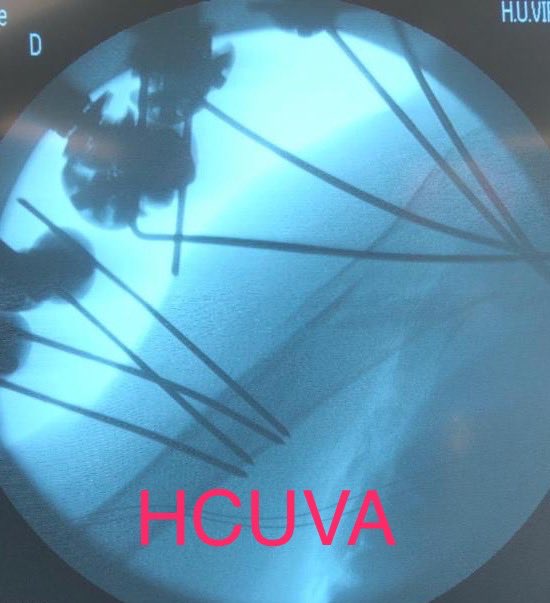 SefexCr's tweet photo. Fractura Compleja de Humero Proximal en paciente de 72 años tratada con Fijador Externo.
En #SEFEX 2019 te mostraremos nuestra Experiencia, juntos con Excelentes Resultados!!!!
@soycot #traumatologia #fractures https://t.co/o8knpoBy9h