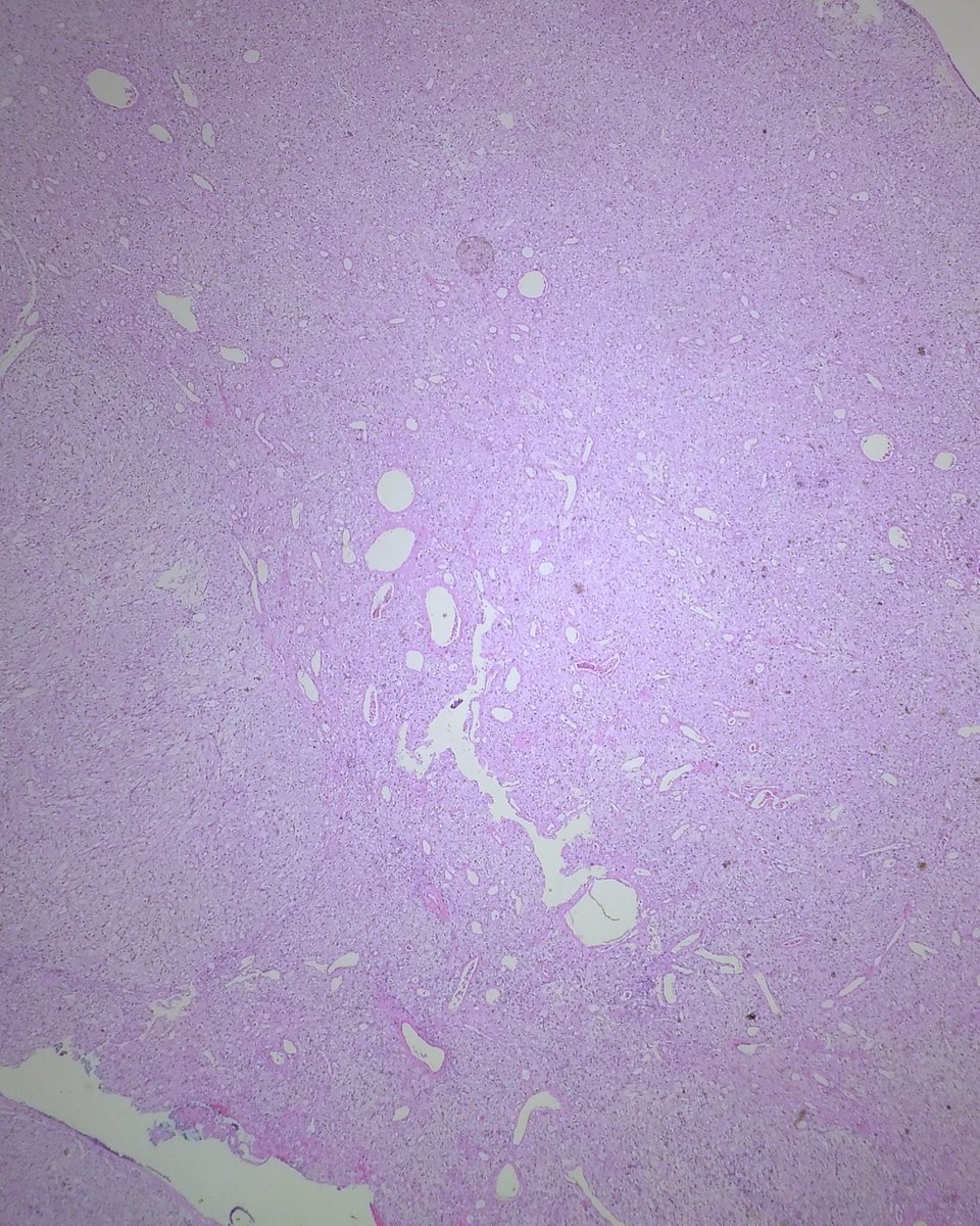 JPZhaoMD's tweet photo. A cool case to share: 60s female, a posterior nasal mass with smooth surface. What would you call? Which IHC to order? Will give answer tomorrow. #ENTPath #bstpath #SurgPath https://t.co/Z8DwgoaqwB