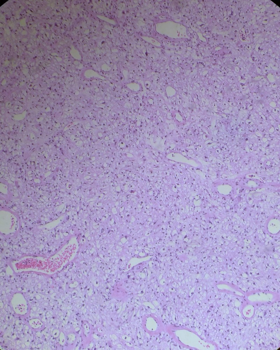 JPZhaoMD's tweet photo. A cool case to share: 60s female, a posterior nasal mass with smooth surface. What would you call? Which IHC to order? Will give answer tomorrow. #ENTPath #bstpath #SurgPath https://t.co/Z8DwgoaqwB