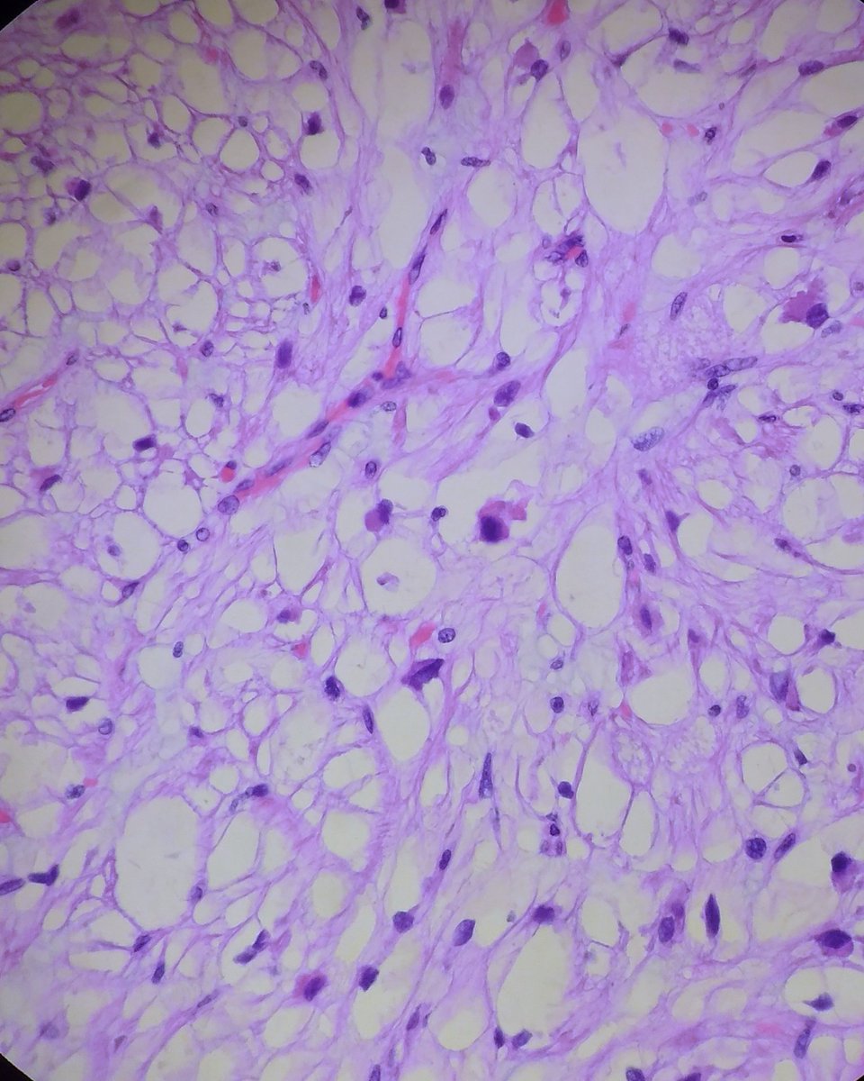 JPZhaoMD's tweet photo. A cool case to share: 60s female, a posterior nasal mass with smooth surface. What would you call? Which IHC to order? Will give answer tomorrow. #ENTPath #bstpath #SurgPath https://t.co/Z8DwgoaqwB