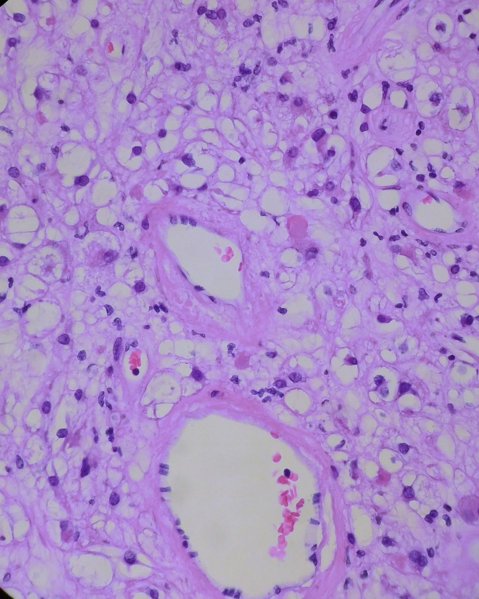 JPZhaoMD's tweet photo. A cool case to share: 60s female, a posterior nasal mass with smooth surface. What would you call? Which IHC to order? Will give answer tomorrow. #ENTPath #bstpath #SurgPath https://t.co/Z8DwgoaqwB