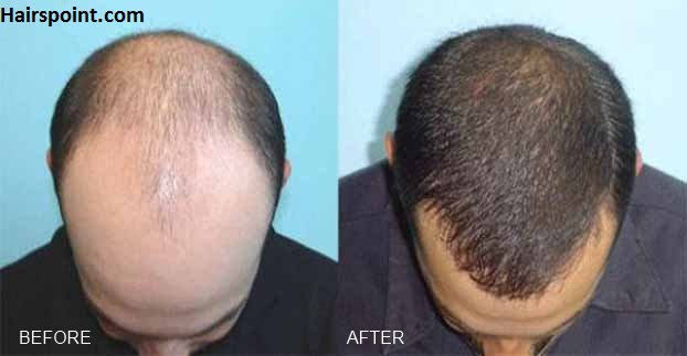 HairsPoint's tweet photo. The best fix by far for replacing hair loss cure is a transplant. Back in the day, docs used plugs that resembled cornrows (definitely not natural looking). Today, guys have more options. https://t.co/mPFvEcN5JG https://t.co/aXYZpUfl12