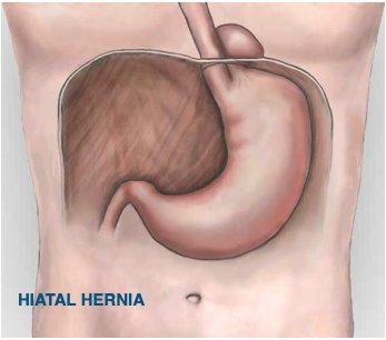 #Haitus #Hernia

The hiatus is an opening in the diaphragm that the oesophagus (gullet) normally passes through. A hiatus hernia is when part of the stomach moves up into the chest through the hiatus.

#herniasurgery