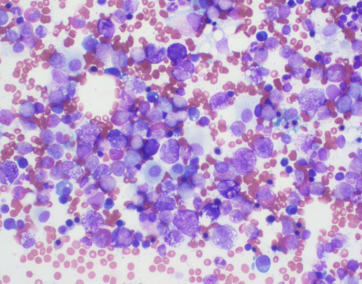 Bone marrow aspirate smear of systemic mastocytosis (20% count) #mastcells #systemicmastocytosis #SM