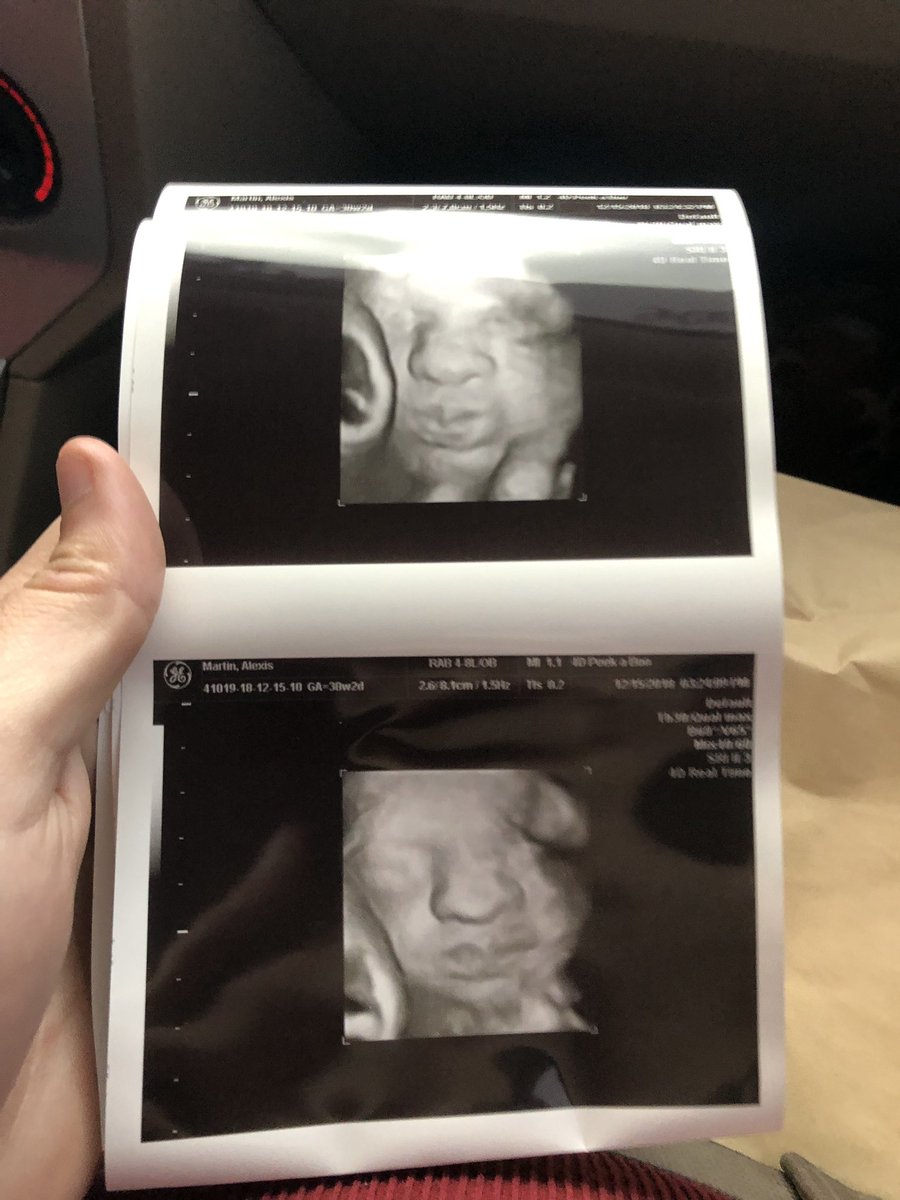 AlexisMitchem's tweet photo. Our daughter is so perfect 💗 she started blowing kisses for her daddy during the ultrasound https://t.co/y68CfK8aFc