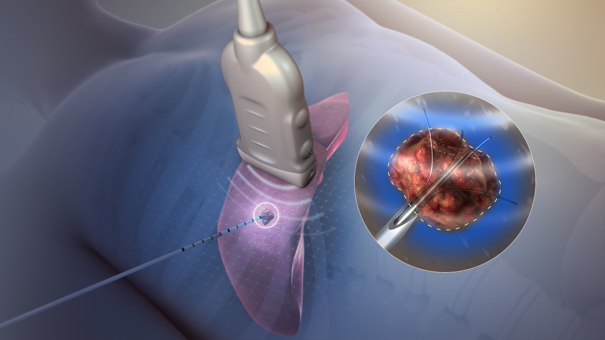 TMDLab (@tmdlab) on Twitter photo Enabled by an @scienceirel equipment grant in 2015, the <a href="/TMDLab/">TMDLab</a> is now supporting two SMEs (<a href="/AurigenMedical/">AuriGen Medical</a> and Atrian Medical) on the development of their ablation technology. Through #DTIF grants, these projects amount to almost €2 million in research funding for @nuigalway Enabled by an @scienceirel equipment grant in 2015, the <a href="/TMDLab/">TMDLab</a> is now supporting two SMEs (<a href="/AurigenMedical/">AuriGen Medical</a> and Atrian Medical) on the development of their ablation technology. Through #DTIF grants, these projects amount to almost €2 million in research funding for @nuigalway