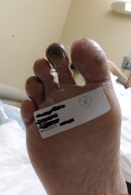 matheenkhuddus's tweet image. Collaborative approach to treat #CLI patient. VS referral to treat distal AT and TPT after fem-pop bypass. TAMI/dual pedal access for retrograde crossing of previous crushed TPT stent, to protect graft flow into AT &amp;amp; treat distal AT. Merit Ideal (slender) sheaths 3Fr OD #SCAIPAD