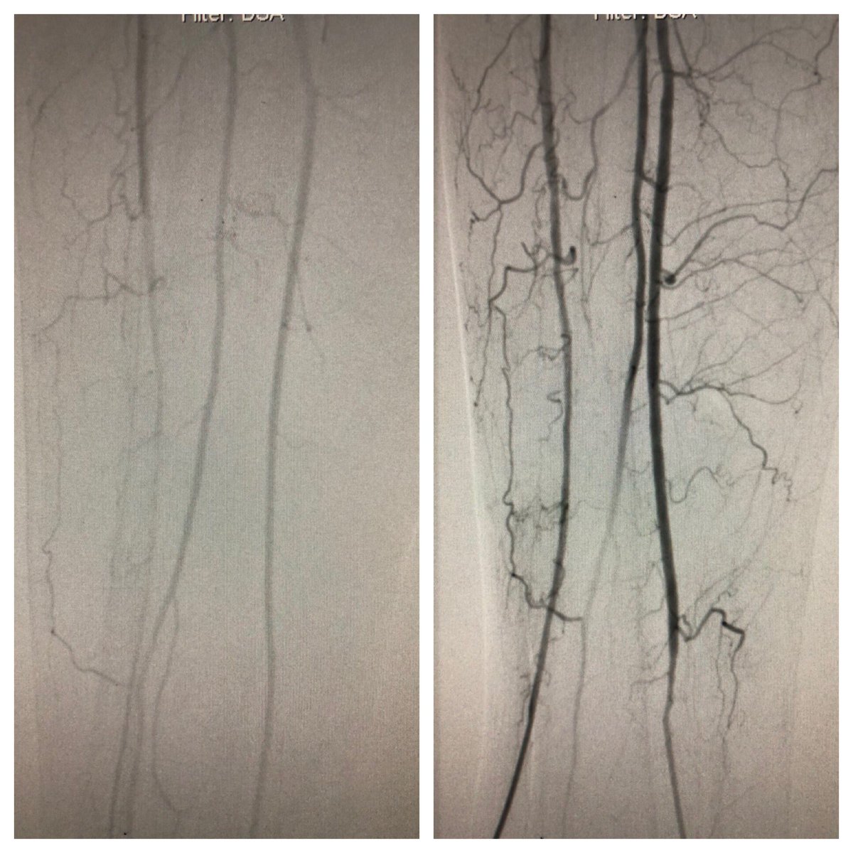 matheenkhuddus's tweet image. Collaborative approach to treat #CLI patient. VS referral to treat distal AT and TPT after fem-pop bypass. TAMI/dual pedal access for retrograde crossing of previous crushed TPT stent, to protect graft flow into AT &amp;amp; treat distal AT. Merit Ideal (slender) sheaths 3Fr OD #SCAIPAD