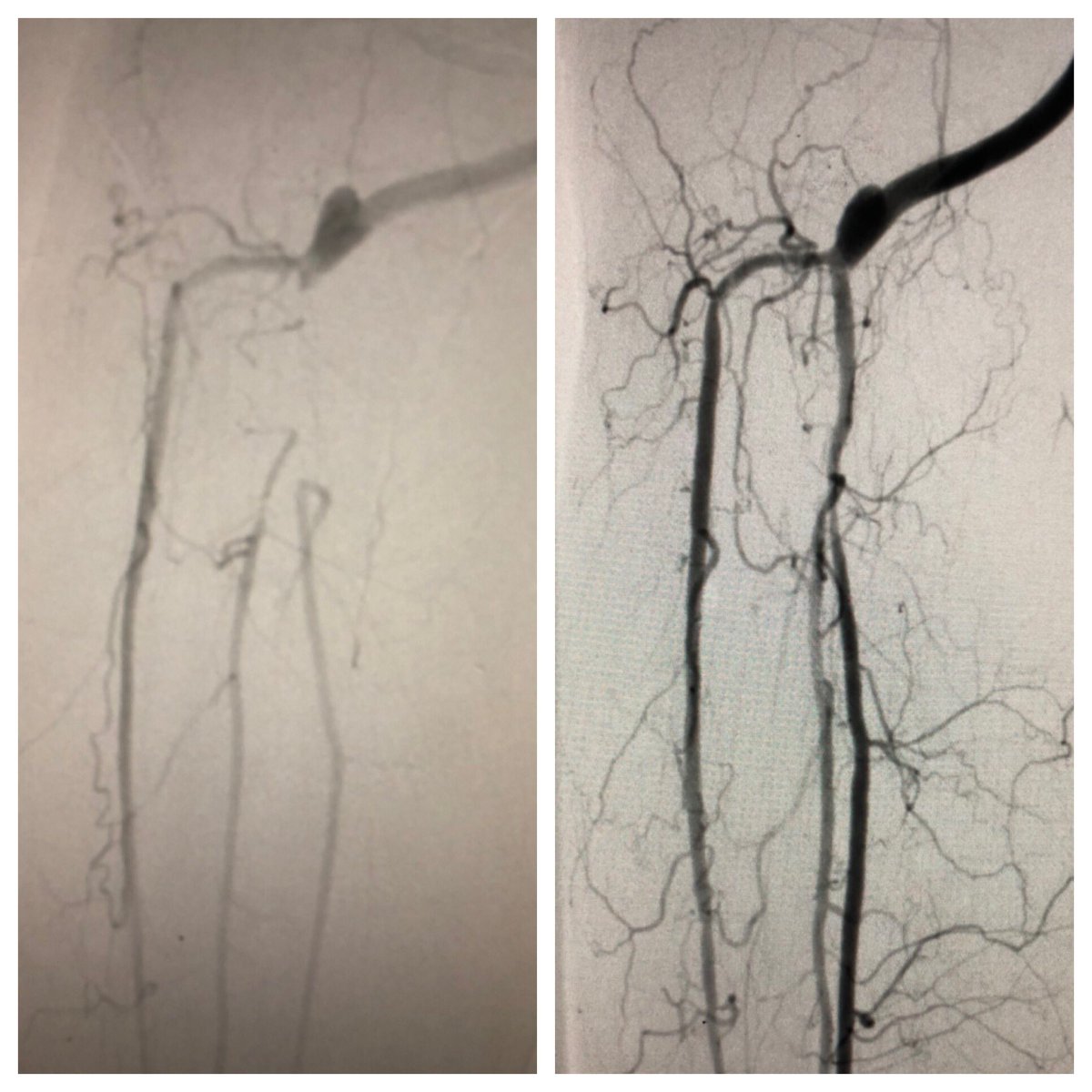 matheenkhuddus's tweet image. Collaborative approach to treat #CLI patient. VS referral to treat distal AT and TPT after fem-pop bypass. TAMI/dual pedal access for retrograde crossing of previous crushed TPT stent, to protect graft flow into AT &amp;amp; treat distal AT. Merit Ideal (slender) sheaths 3Fr OD #SCAIPAD
