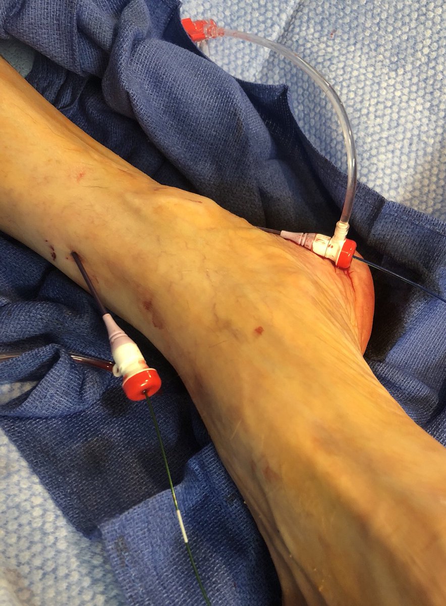 matheenkhuddus's tweet image. Collaborative approach to treat #CLI patient. VS referral to treat distal AT and TPT after fem-pop bypass. TAMI/dual pedal access for retrograde crossing of previous crushed TPT stent, to protect graft flow into AT &amp;amp; treat distal AT. Merit Ideal (slender) sheaths 3Fr OD #SCAIPAD