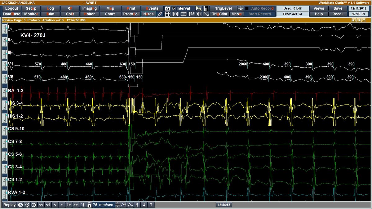 MicheleB_MD's tweet image. How to induced typical AVNRT in Magdeburg :) 
This pt was referred for Ablation due to SVTs, ECG documentation pointed to typical #AVNRT, During #XRayfree #catheterablation,  AFib was induced several time. After CV nr 4 ... #Claris #EnsitePrecision #Epeeps #EP_nerd